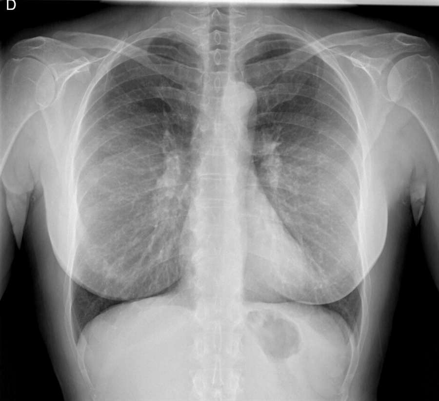 Radiographie pédagogique montrant des implants mammaires, 2024.